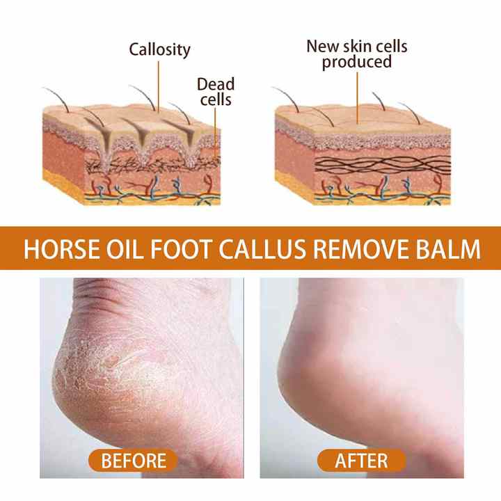 Horse Oil Foot Callus Remedy Balm YT